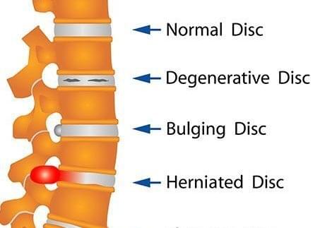 Spinal anatomy illustration comparing a normal disc, degenerative disc, bulging disc